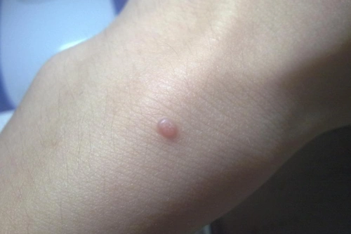 寻常疣的症状表现