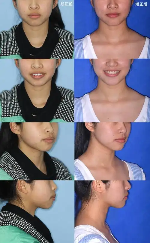 牙齿整齐但嘴突?牙齿矫正同样有效!