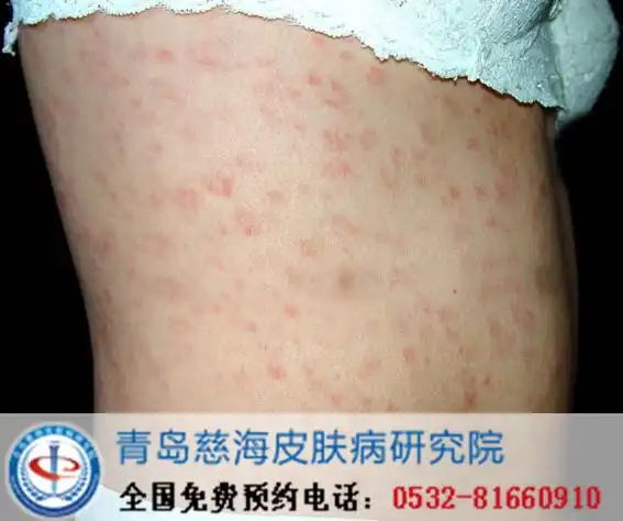 淋病不治愈的危害