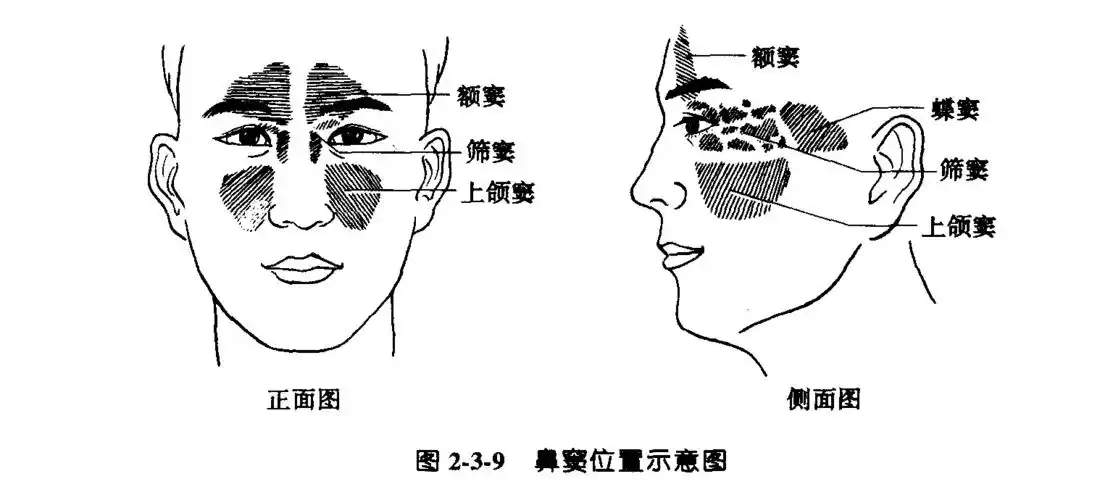 双侧上颌窦炎伴液体潴留是什么意思
