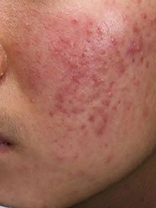 这位患者经面诊是痤疮,脂溢性皮炎,曾经应用可疑含激素护肤品,皮肤