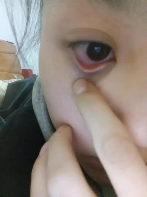 隐形眼镜大概隔了半个月没戴,前天刚戴的然后下午就发现眼角红了,不疼