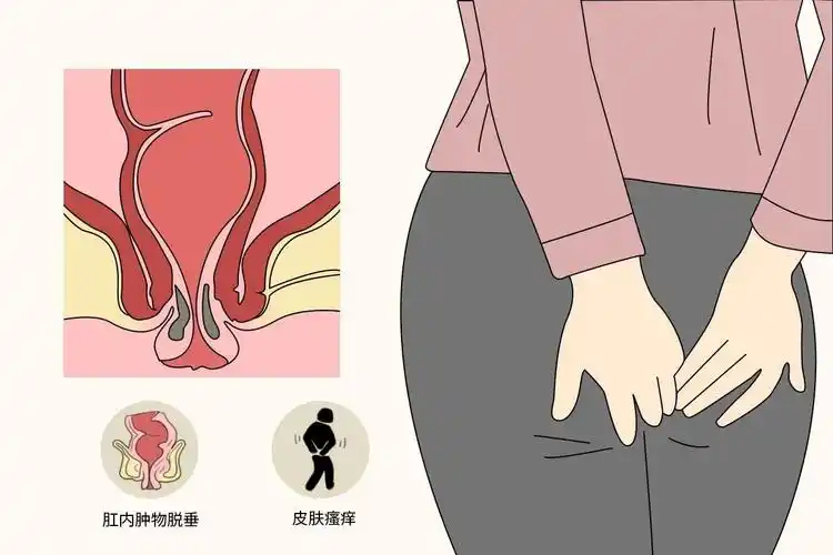 肛门脱垂的症状图片_39健康网_精编内容