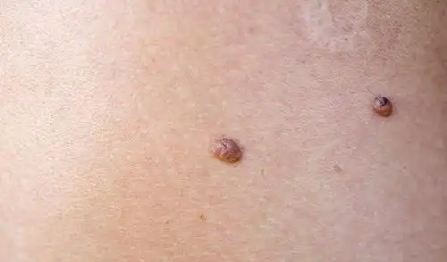 身上有这种痣要小心了 有可能发生癌变_症状