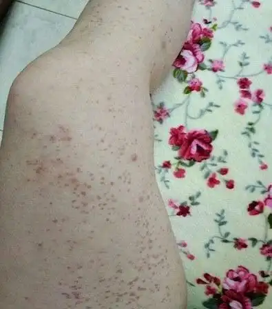 身上长了小红点,是肝病的表现吗?3个潜藏病因,了解一下