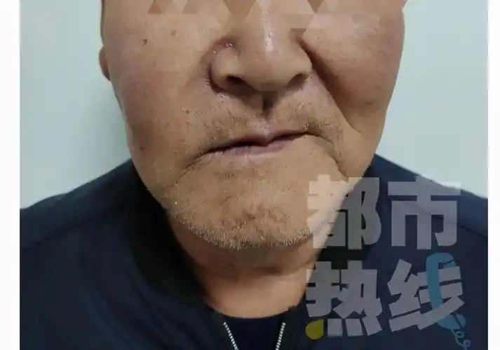 脸颊变形还疼得不行,男子鼻窦囊肿,原来是牙齿长进了鼻子里_上颌