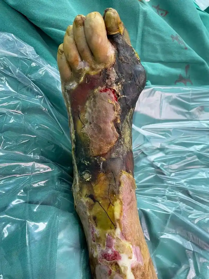 可怕的糖尿病足