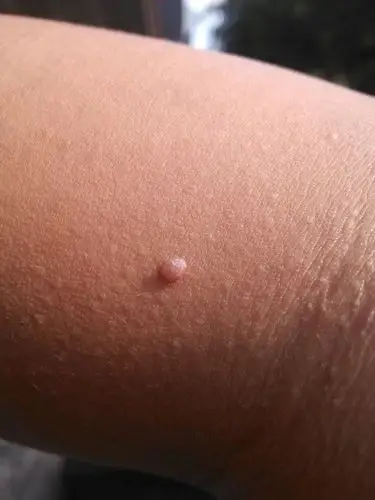 小手臂上长了一个小疙瘩,有图片.