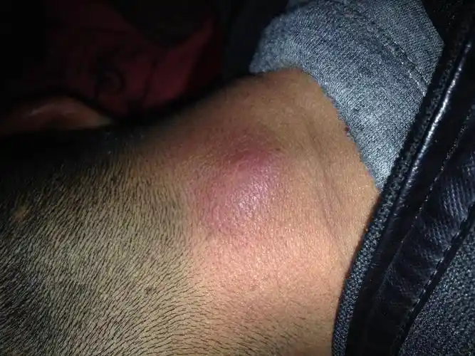 脖子后面长硬包包好几年了不痛不痒最近突然肿起来胀痛是什么原因