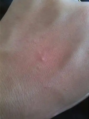 疥疮的初期症状图片 (17)