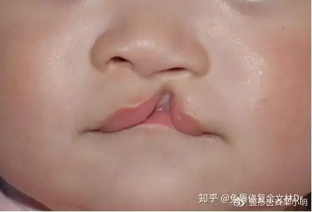 兔唇修复余文林dr 唇裂修复专家余文林解答:唇裂的常见问题(下) 状浇