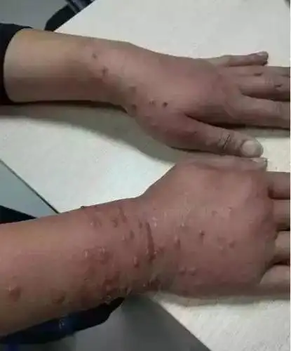 千万要小心遇到这种虫子万万拍不得其毒液会导致皮肤溃烂