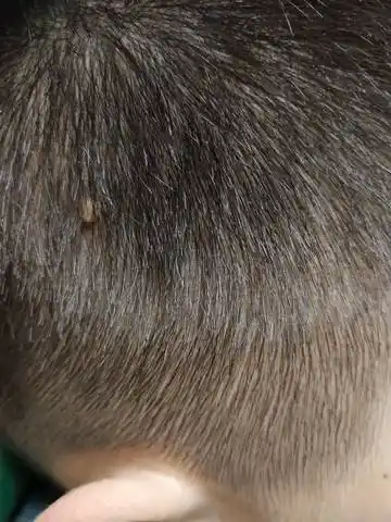 儿子头上长了个软疙瘩,不痛不痒,是怎么回事?