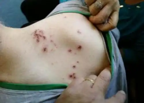 镇静剂效果强 病人遭老鼠啮咬多处毫无知觉(图)