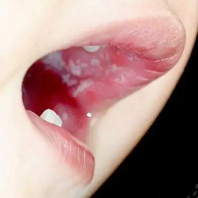 小儿鹅口疮哪家医院看的好,治疗小儿鹅口疮哪个医生好,小儿鹅口疮推荐