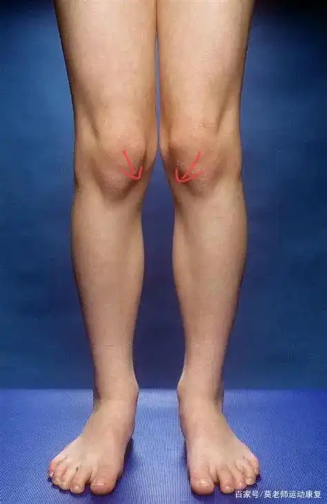 x型腿有的人是股骨(大腿骨)会内旋(如下图膝盖朝向内),有的人股骨会外