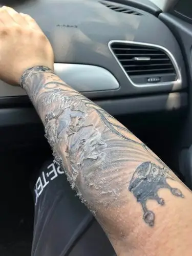 我的纹身蜕皮这样是正常的吗?我是划痕性肤质