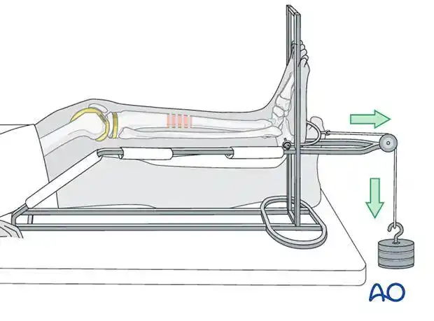 看完骨科医生打牵引,我整个人都不好了.