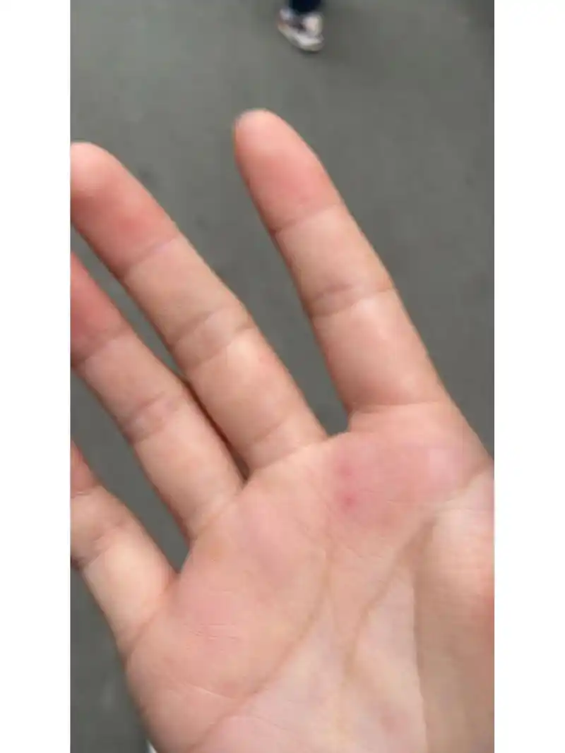 上突然出现的这两个小红点是什么呀 求告知啊 刚刚开始的时候不痛不痒