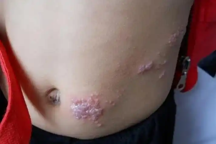 腰腹部蛛蛛疮图