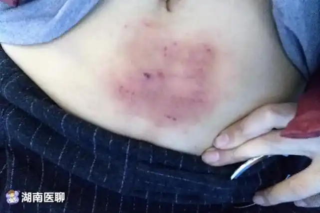 长沙一女子网购工具艾灸祛湿10天后皮肤烫成这样