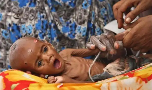 这些儿童从出生起就一直挨饿,长期的营养不良让他们生死由天