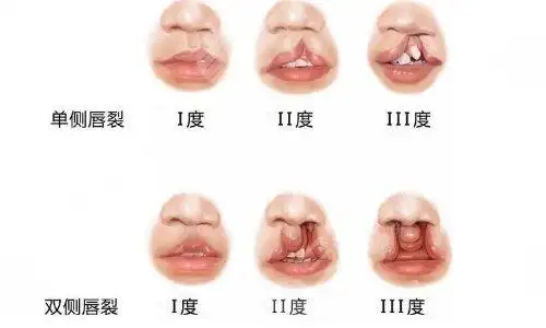 发生在婴儿出生后,是指从唇红到鼻孔,然后组织裂缝,这种情况称为唇裂