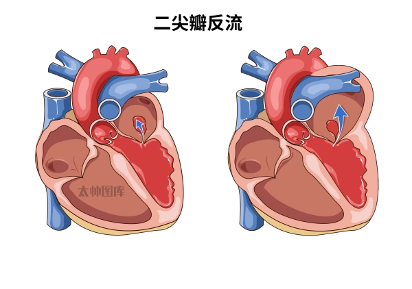 二尖瓣反流