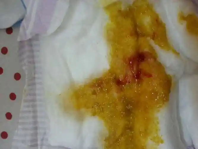 2个月宝宝,大便里带血