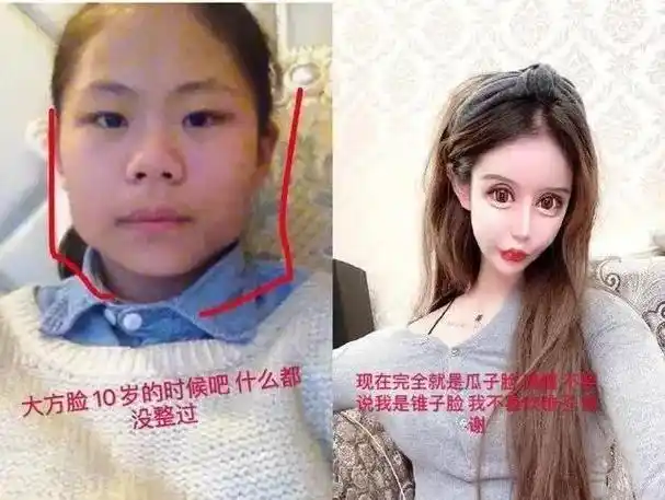 女孩不满意外貌13岁开始整容,百余次手术花费100w,堪称"换脸"