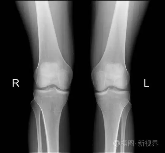 x射线的正面投影正常膝关节