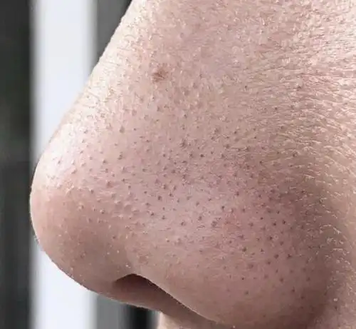 鼻子总是被黑头"纠缠",别再用指甲挤,试试这几招,黑头去无踪_毛孔