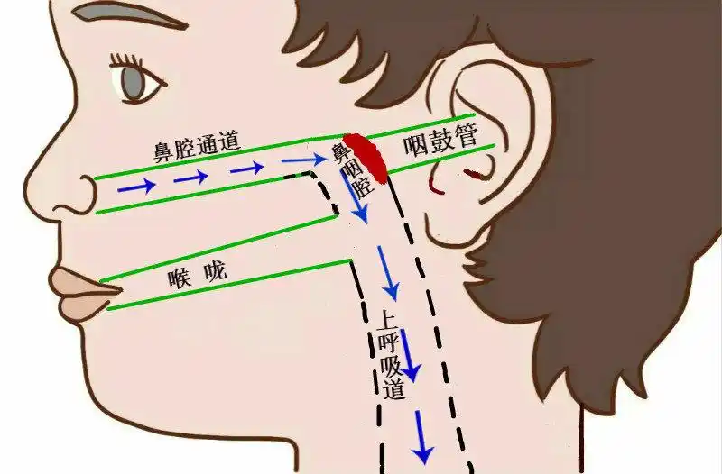 腺样体是啥?为什么肥大就惹祸?