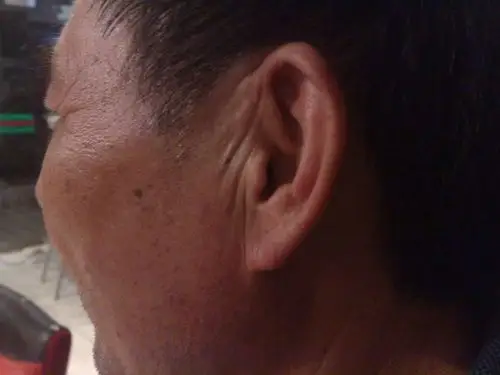 我的一个叔叔50多岁有糖尿病,耳朵周围皮肤最近有皱褶,请问出现这种