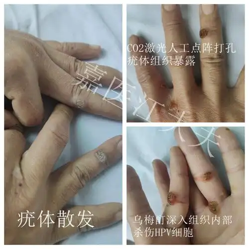 co2点阵激光结合中药治疗病毒疣