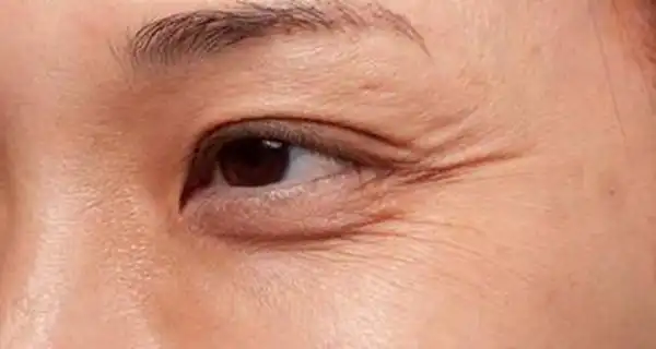 脸上皱纹增多吃猪蹄管用医生想要改善皱纹需养成这个习惯