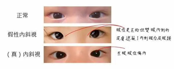 当我们在诊室如果碰到内斜视的患儿,我们会让家长先先回去给宝宝用