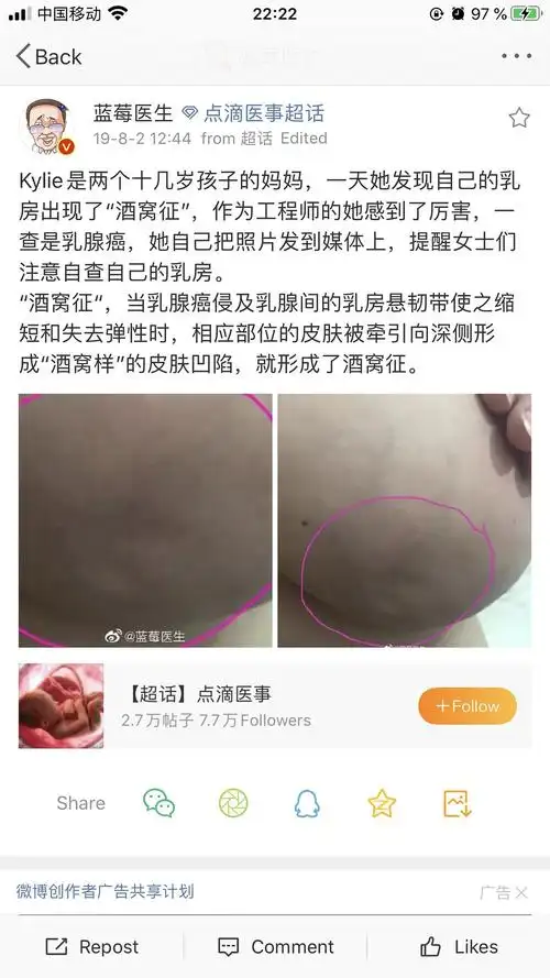 关注的医学博主科普关于乳腺癌的"酒窝征"特点,即当乳房出现酒窝状时