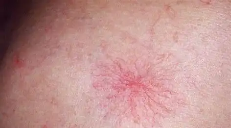 47岁男子,查出肝癌,提醒:身体出现1臭2黄3红,及时查肝功_肝癌-养肝