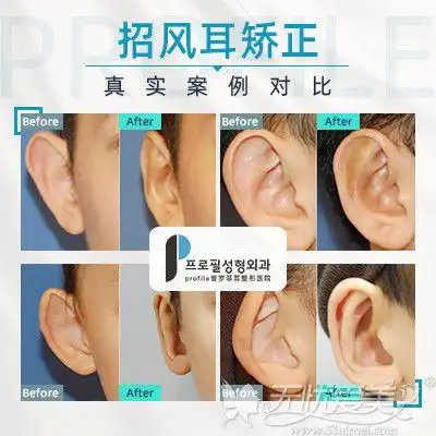 双耳不对称造成的大小脸只需耳整形就可以解决了