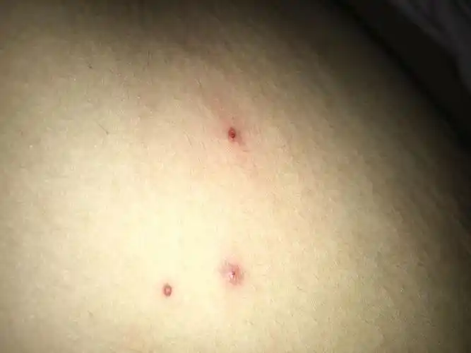 乳房外侧长这个东西 挤出来像粉刺一样 这是什么?