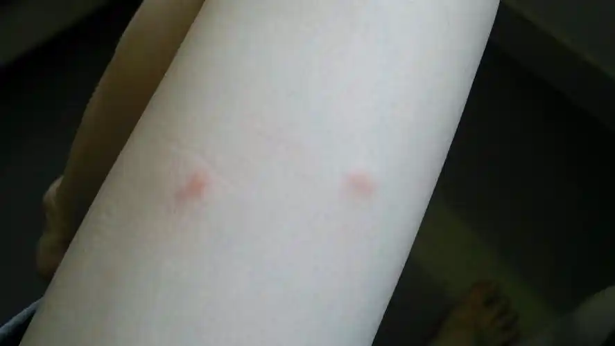 昨晚开了空调睡觉.早上醒来皮肤超痒.身上长了很多这个红疙瘩.