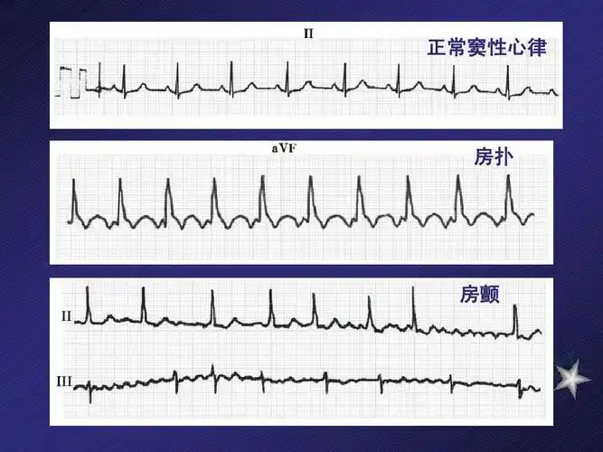 正常窦性心律 房扑 房颤