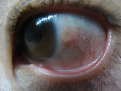 青光眼失明后眼睛为什么会出现视物感觉