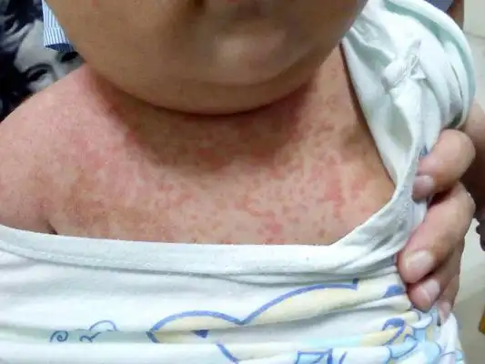 红疹子图片 (1)_有来医生