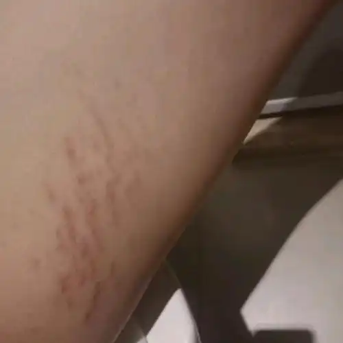 想问一下大家这个是什么纹,橘皮组织?肥胖纹?