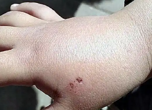 没有儿童可用疫苗,如果儿童被老鼠咬伤该怎么办呢?