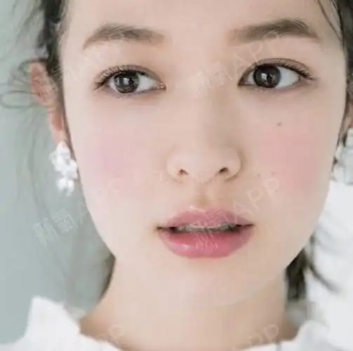 分享一组自然型的双眼皮模板,给准备做眼睛功课的集美_圈子-新氧美容