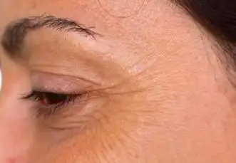 岁月从不败美人 显老的眼角纹可以这样祛除