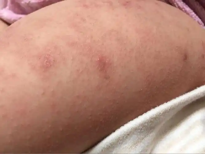 宝贝身上起东西 全身都是 跟癣一样 有没有医生帮我看看这是什么东西